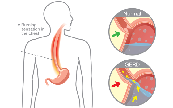 แสบร้อนกลางอก สัญญาณอาการกรดไหลย้อน